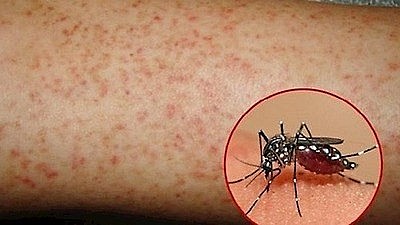 Bệnh sốt xuất huyết là một bệnh xảy ra phổ biến ở vùng khí hậu nhiệt đới do vi rút Dengue gây ra. Ảnh minh họa